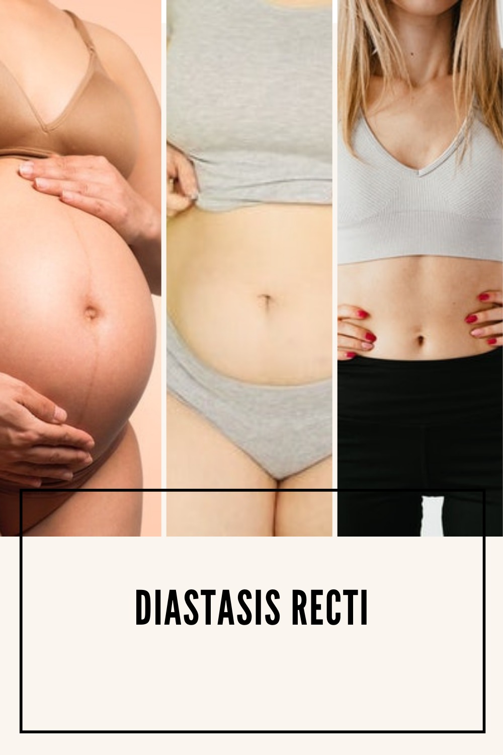 Read more about the article DIASTASIS RECTI
