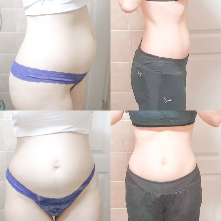 diastasis results in 3 months